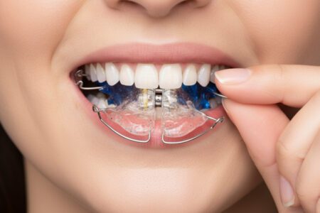 Lose Zahnspange (aktive Platte) beim Einsetzen – sanfte Zahnkorrektur für Kinder und Jugendliche bei Skyline Kieferorthopädie Frankfurt am Main, direkt an der Europa-Allee im Europaviertel.